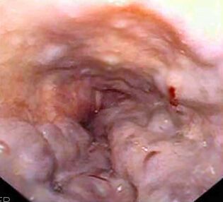 File:Esophageal varices - wale.jpg