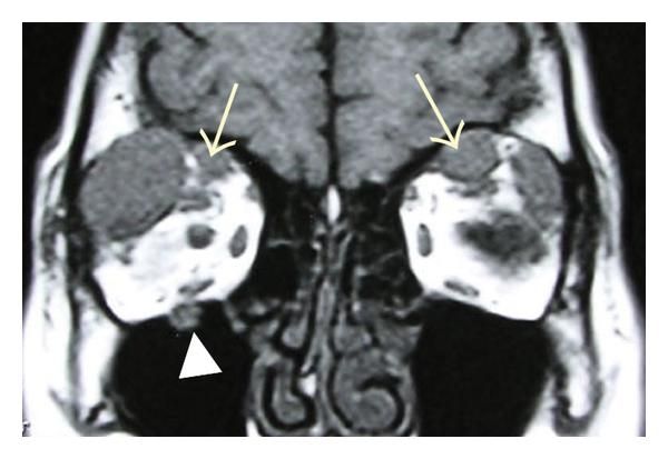 File:Orbital nerve enlargement in IgG4-ROD.jpg