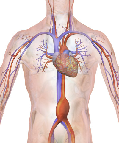 File:Blausen 0001 AbdominalAorticAneurysm 01.png