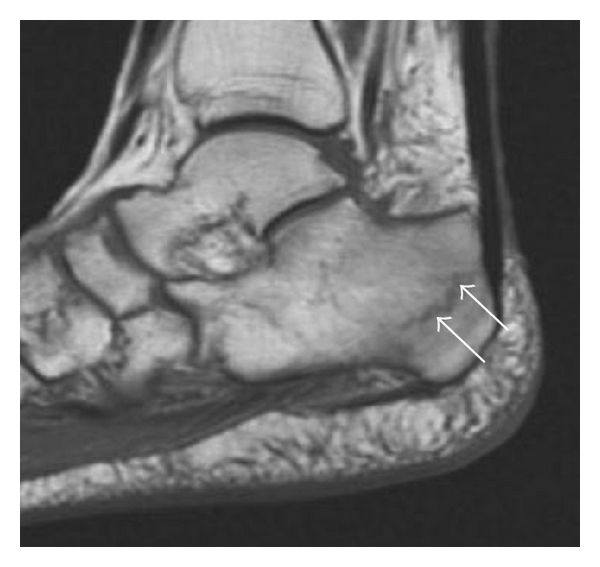 File:T1 MRI of calcaneal fracture.jpg