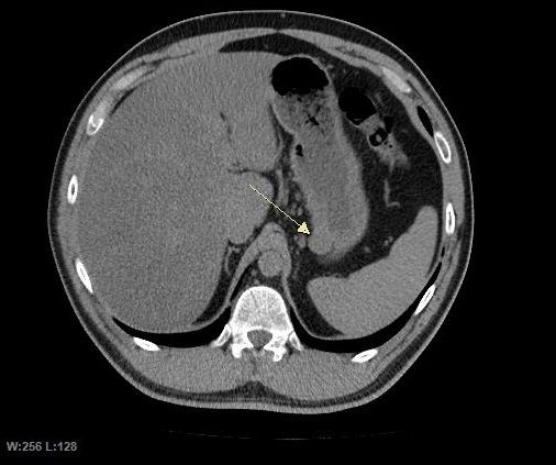 File:GIST CT image.jpg