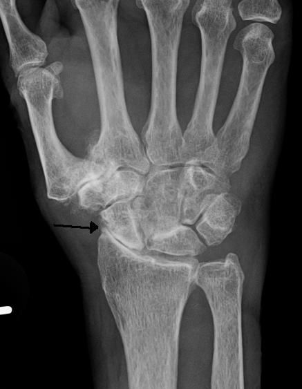 File:Osteo of the hand.jpg