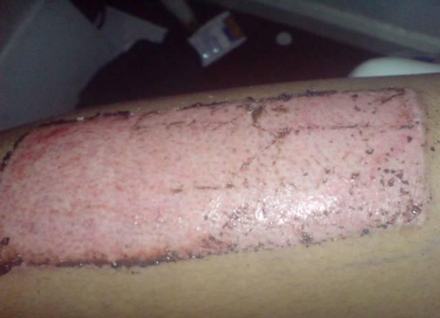 File:Skin graft donor site.jpg