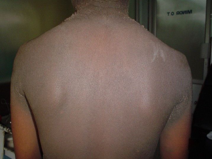 File:Familial acanthosis nigricans2.jpg