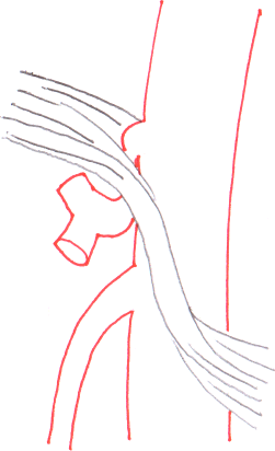 File:Median arcuate ligament syndrome anatomy.png