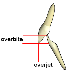 File:Overjet-overbite.png