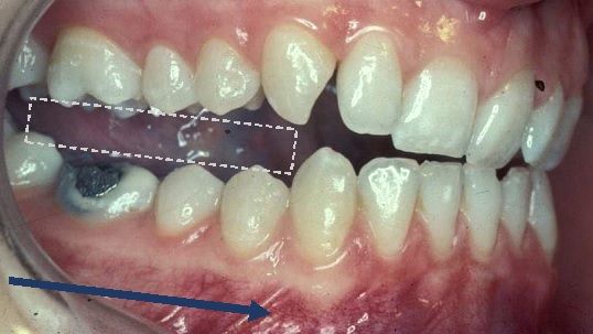 File:Posterior disocclusion.jpg