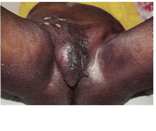 File:Adenopatía inguinal.png