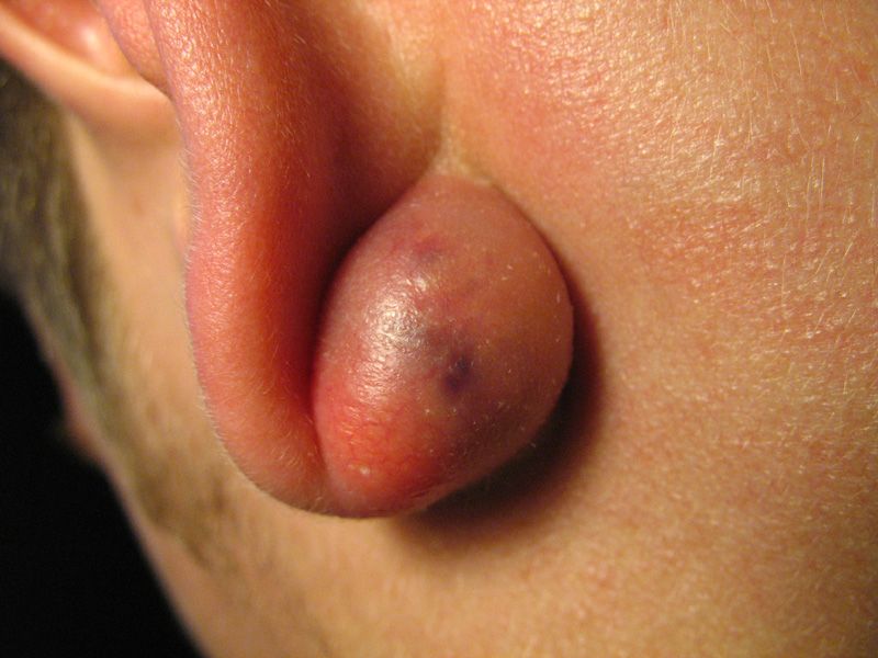 File:Sebaceous cyst.jpg