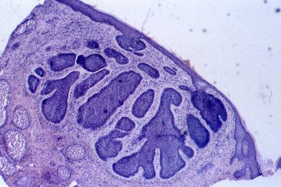 File:Basal cell carcinoma pathology.jpg