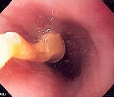 File:Food bolus obstruction (cropped).jpg