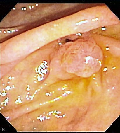 File:Ampulla endo.jpg