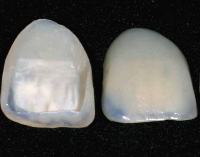 File:Dental veneer.jpg