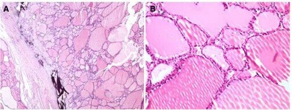 File:Histopathology of multinodular toxic goiter.jpg