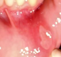 File:Mouth sore.JPG