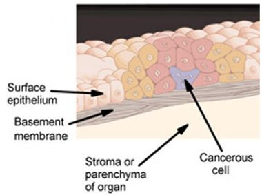 File:In situ carcinoma.jpg