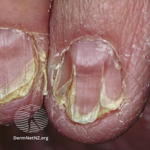 File:Darier disease nails.jpg