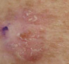 File:Actinic keratosis, left upper paraspinal back.jpg