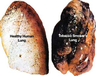 File:Healthy lung-smokers lung.jpg