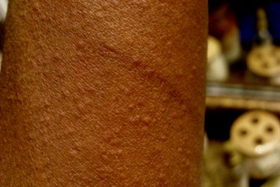 File:Cholinergic urticaria.jpg