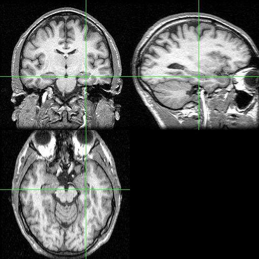 File:Hippocampus-mri.jpg