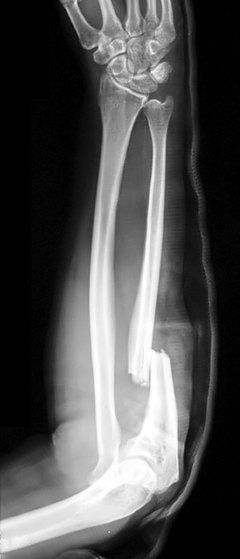 File:Monteggia Fracture.jpg