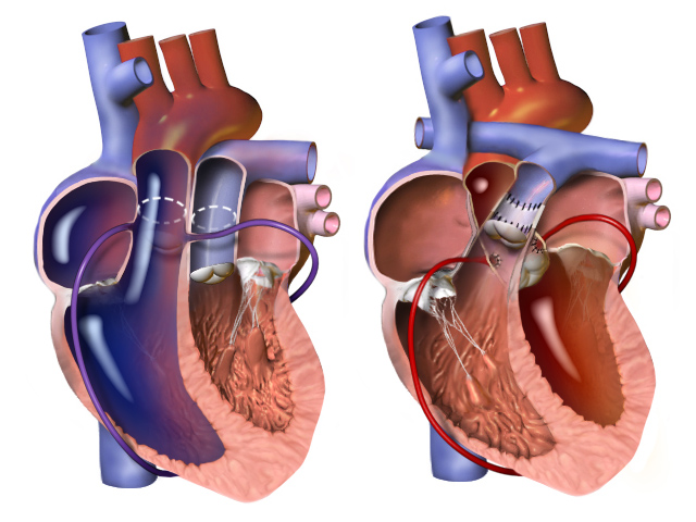 File:Blausen 0047 ArterialSwitchOperation 02.png