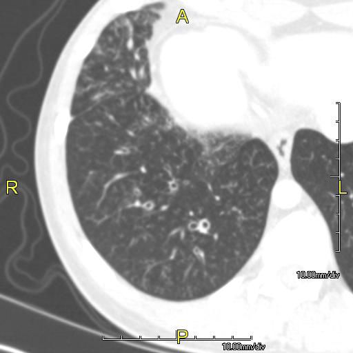 File:Primary ciliary dyskinesia-1.jpg