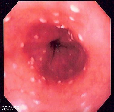 File:Esophageal candidiasis.jpg