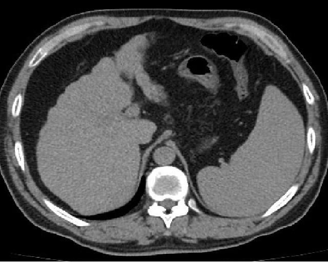 File:Liver cirrhosis.JPG