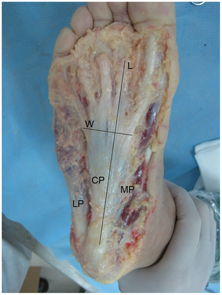 File:Plantar aponeurosis - axial view.png