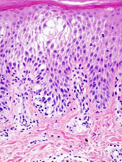 File:Spongiotic dermatitis (2) Dyshidrotic.JPG