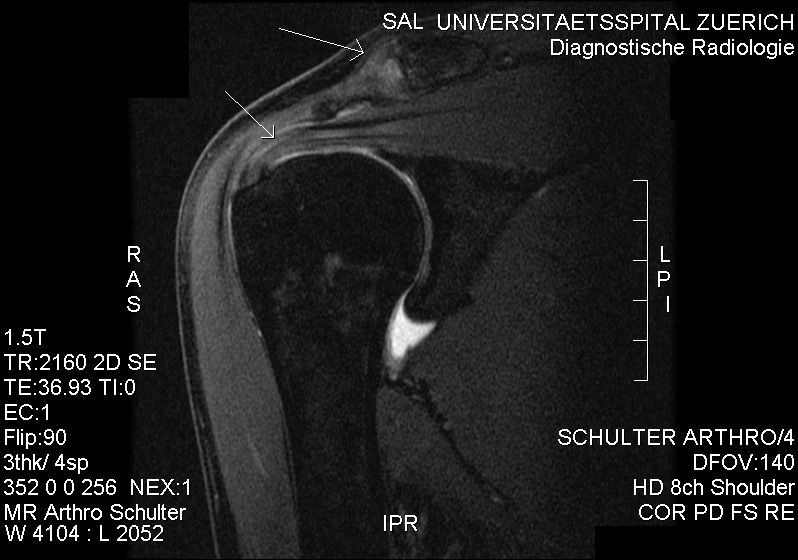 File:MRI. Subacromial impingement..jpg