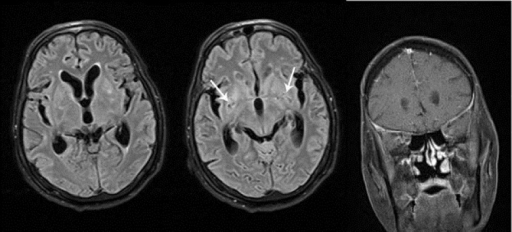 File:Meningitis criptocócica diseminada.png