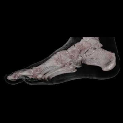 File:CT 3D human Foot Skin and Bone.jpeg