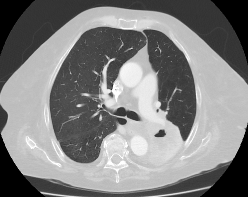 File:CT scan of lung cancer with cavitation.png