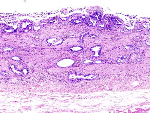 File:Gallbladder adenocarcinoma (1) histopathology.jpg