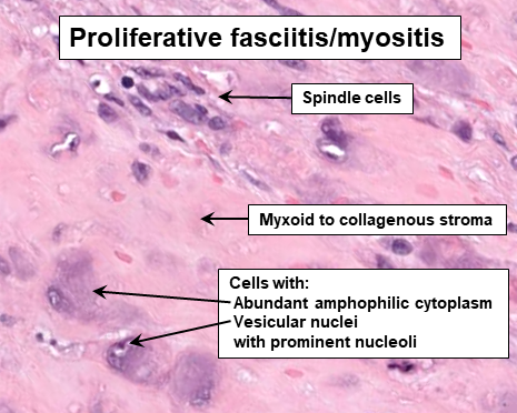 File:Histopathology of proliferative fasciitis or myositis.png