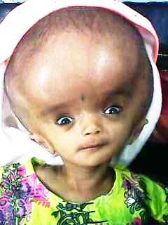 File:Hydrocephalus with sunset eyes.jpg