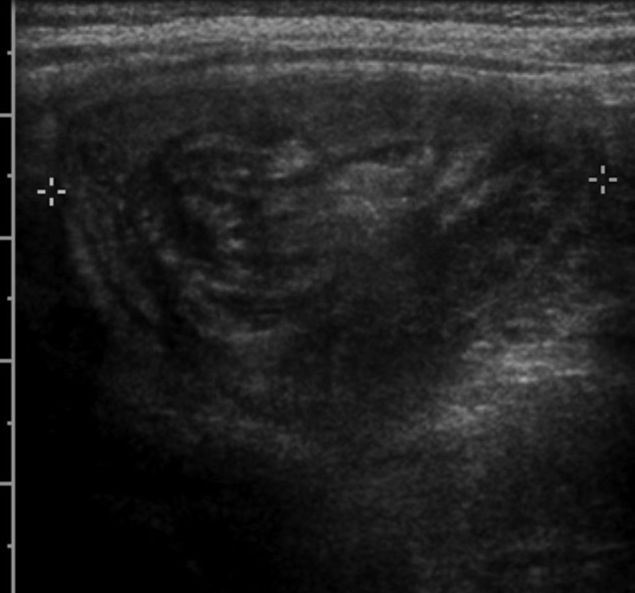 File:Intussusception on ultrasound.jpg