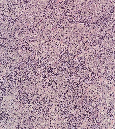 File:Lymphoepithelioma met to LN 5.jpg