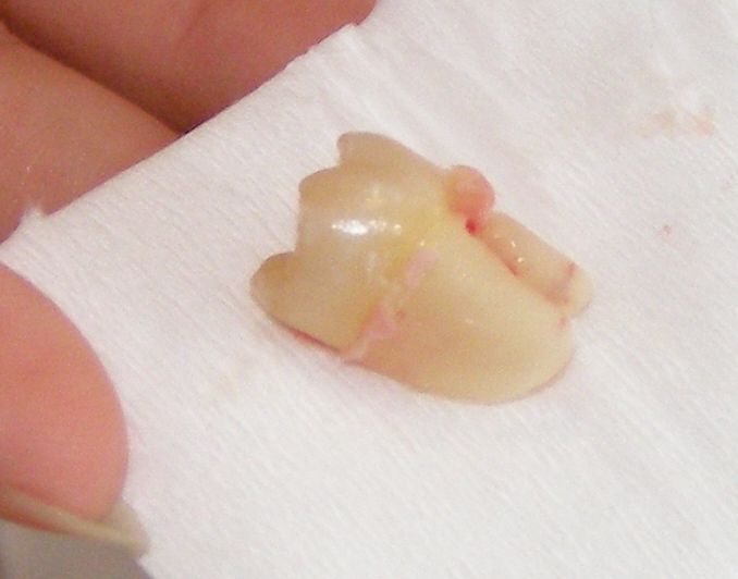 File:Extracted Wisdom Tooth.jpg