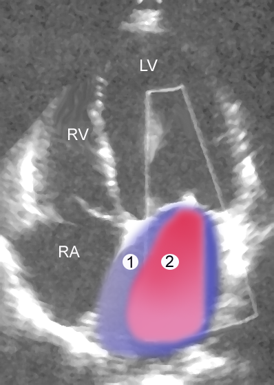 File:Mitral regurgitation echo 4chamber description.png