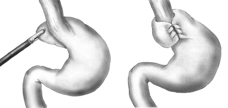 File:Nissen fundoplication.png