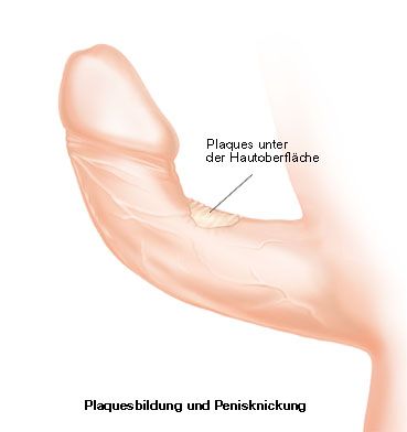 File:Dorsale Deviation.jpg