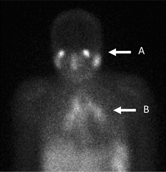 File:Gallium 67 Scan (Diagnosis of Sarcoidosis).png