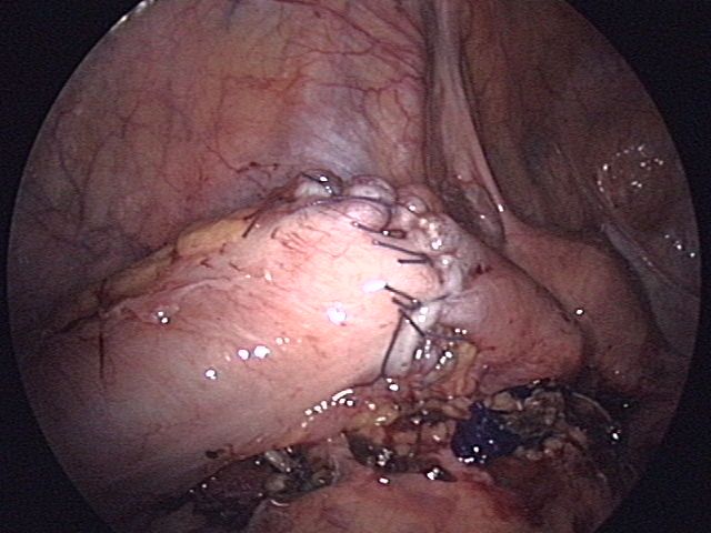 File:Manual anastomosis of sigma colon.JPG