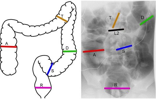 File:Main measuring sites of colon diameter.jpg