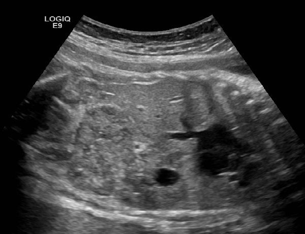 File:Ectopic crossed fused kidney.jpg