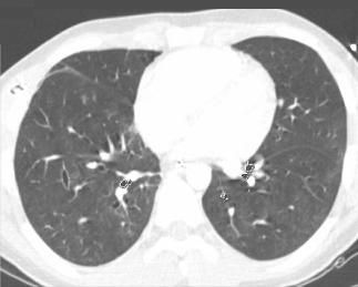 File:Healed pulmonary contusion.JPG